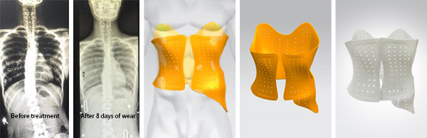 3D printed spinal orthosis 